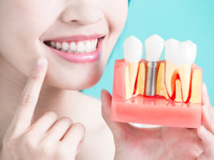 implantes dentários